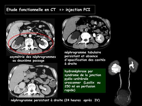 Ppt Imagerie Et Obstruction Urinaire Powerpoint Presentation Free