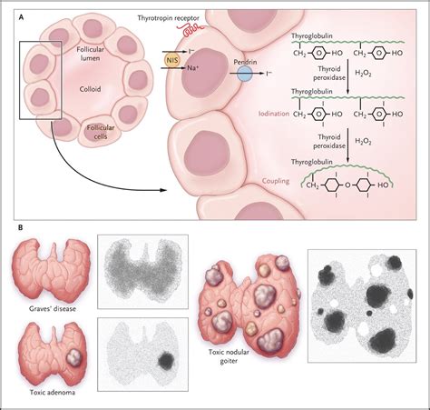 Pin On Hyperthyroidism And Hypothyroidism