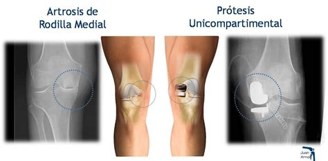 Disipar Cavar Sustantivo Tratamiento Para Pinzamiento De Rodilla