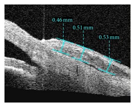 Imaging Of As Oct Shows Measurement Of Thickness Of The Conjunctival Download Scientific