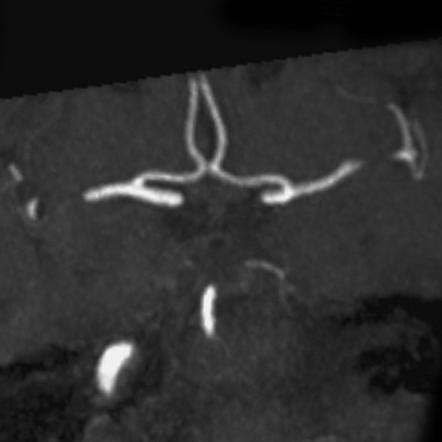 Anterior communicating artery | Radiology Case | Radiopaedia.org