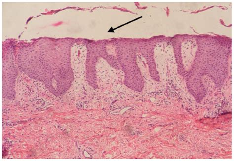 Glucagonoma Syndrome A Case Report With Focus On Skin Disorders Ott