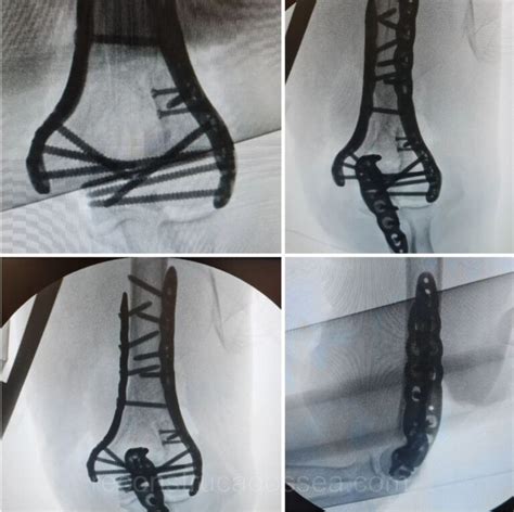 Fraturas Do Umero Distal Dr S Vio Chami