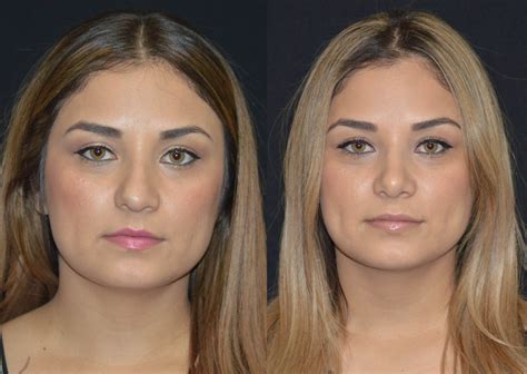 Rhinoplasty Before And After Photos