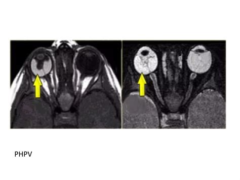 Diagnostic Imaging Of Orbital Lesions Ppt