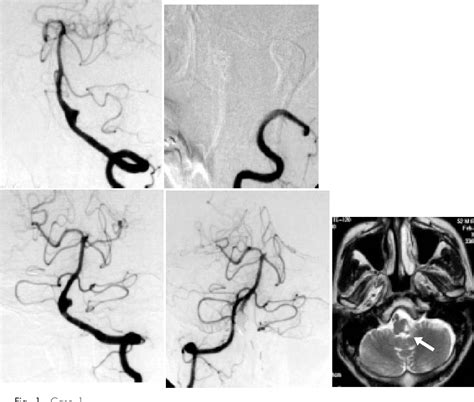 Figure 1 From Indication And Pitfall Of Endovascular Treatments For