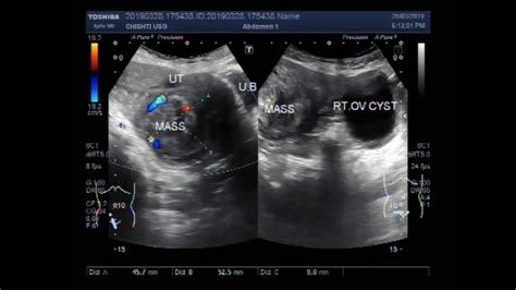 Ultrasound Video Showing Fibroid With Ovarian Cyst Youtube