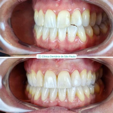 Ortodontia Pediátrica Clínica Dentária São Paulo