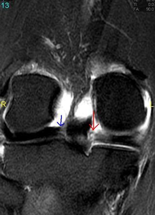 Meniscus Root Tear Mri