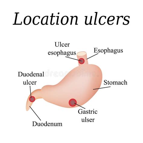 Ulc Re D Oesophage Affect Ulc Re D Oesophage Illustration De Vecteur