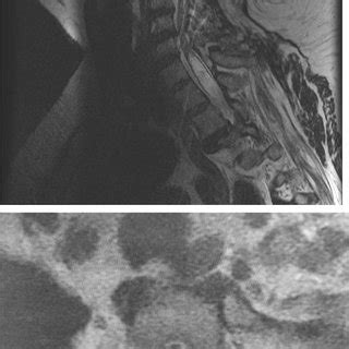 Magnetic Resonance Imaging T2 Signal Sagittal And Axial Cervical Spine