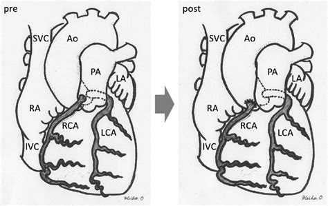 Figure7.Ao: aortic artery, RCA: right coronary artery, PA: pulmonary ...