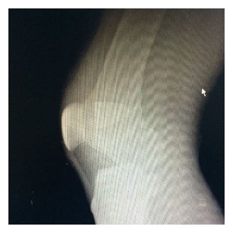 A Lateral Radiographic Examination Of The Knee B Anteroposterior