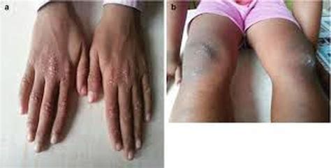 Juvenile Dermatomyositis Medizzy