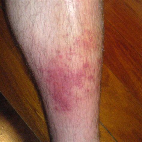 Collection 96 Images Pictures Of Staph Infection On Legs Superb