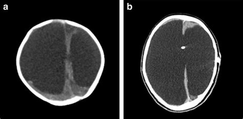 Case 3 A Ct Demonstrating Hydranencephaly B Ct Obtained At 8 Years Of