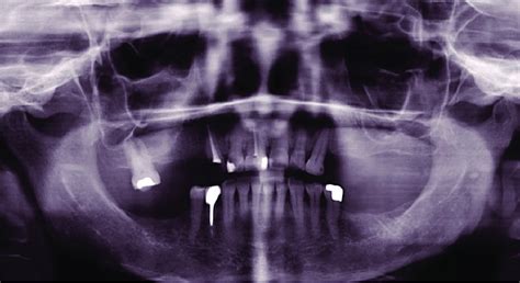 Orthopantomogram Of A 65 Year Old Patient With Osteoporosis Note The