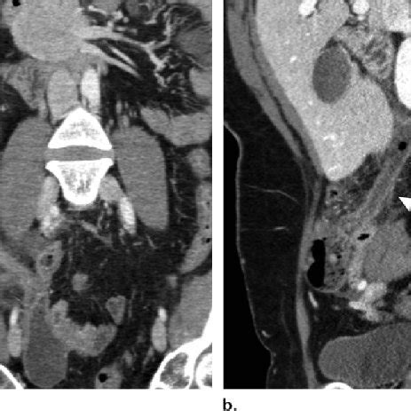 Intussusception In A 63 Year Old Man With RLQP A Palpable Mass