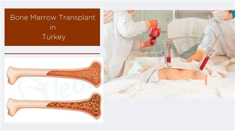 Bone Marrow Transplant Cost In Turkey Procedure Medsurge India