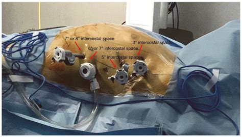 Jcm Free Full Text Robotic Assisted Epicardial Hybrid Ablation And