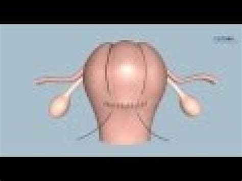 How To Perform A B Lynch Uterine Compression Suture Youtube