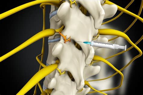 Medial Branch Blocks Facet Injections Pain Medicine Located In