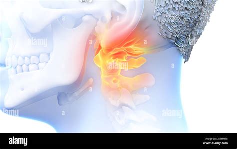 Painful atlas bone, illustration Stock Photo - Alamy