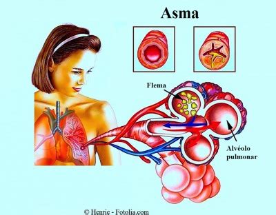 Asma Bronquial Y Al Rgica Tipos Causas Y Diagn Stico