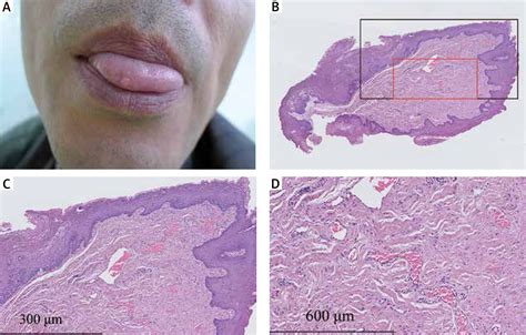 Irritation Fibroma Histology