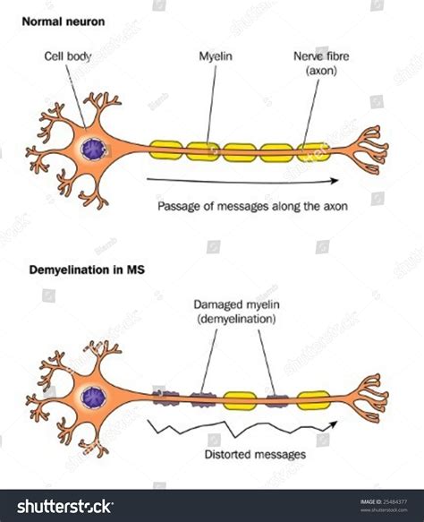 Demyelination In Multiple Sclerosis Labeled Stock Vector Illustration