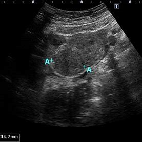 ultrasonographic images   left abdomen   transverse plane