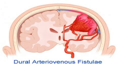 What Is Dural Arteriovenous Fistulas: Symptoms And Causes - SuccessYeti