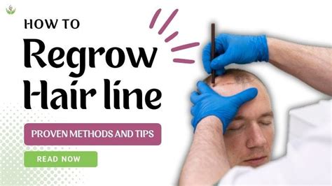 How To Regrow Hairline Introduction By Care Well Medical Centre