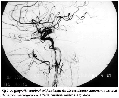 SciELO Brasil Fístula arteriovenosa dural intracraniana