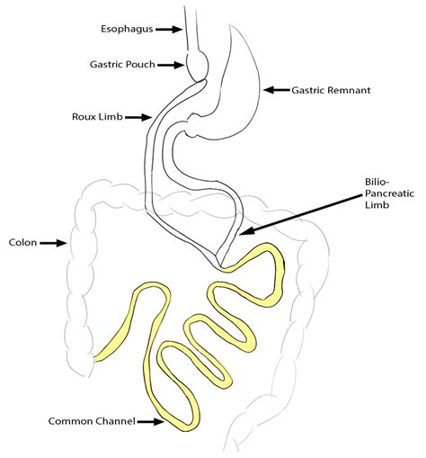 Roux En Y Gastric Bypass Afferent Limb