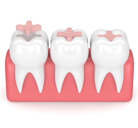 Dentist On Main Dentist Cape Town Scaling And Polishing Teeth