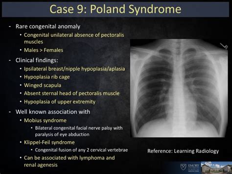 Poland Syndrom MOOCI Poland Syndrom Wenn Teile Des Brustmuskels