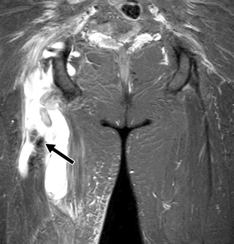 Mri For Hamstring Injury