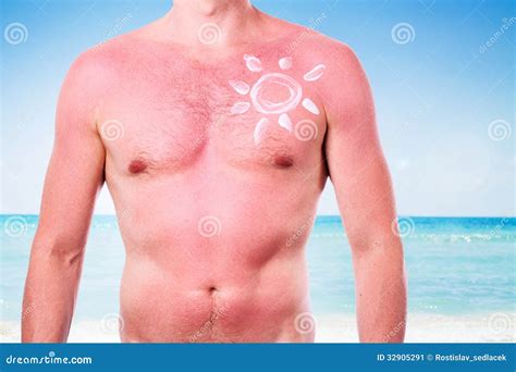 Homme Avec Un Coup De Soleil Image Stock Image Du Orange Nudité