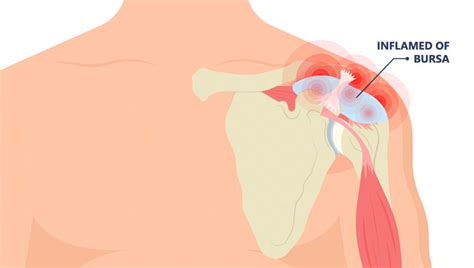 Shoulder Impingement Syndrome Rubbing Rotator Cuff Outline Diagram