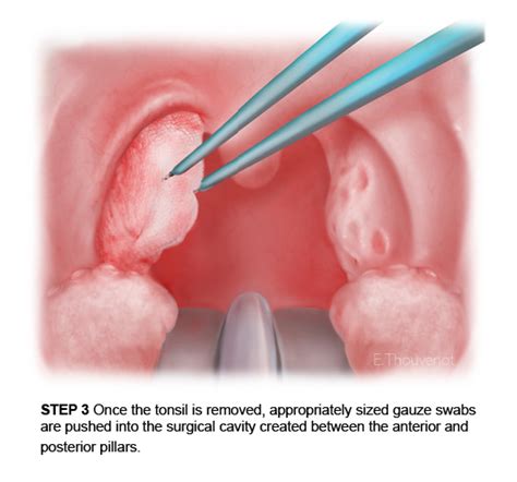 Tonsillectomy — Elvire Thouvenot Nitzan