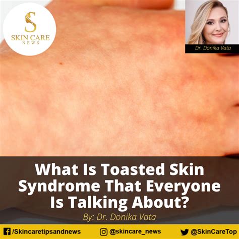 toasted skin syndrome    talking