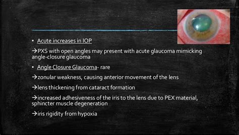 Pseudoexfoliation syndrome