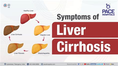 Liver Cirrhosis — Symptoms Causes Complications And Prevention By