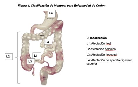 Conociendo La Enfermedad Inflamatoria Intestinal Vivir Con Crohn Y Cuci