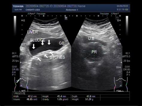 Ultrasound Video Showing Gall Bladder Stones And Sludge Differentiation