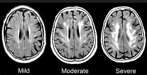 Chronic Ischemic Microvascular Changes