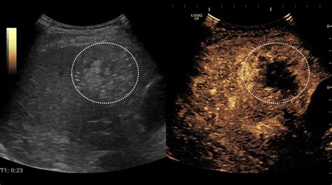 Contrast Enhanced Ultrasound CEUS Showing Intense Peripheral