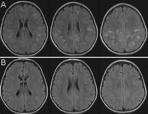 Images of acute disseminated encephalomyelitis (ADEM) in a pediatric ...