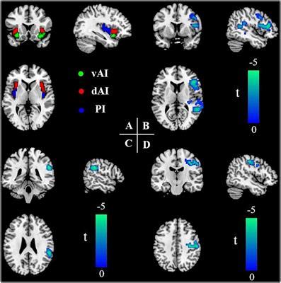 Frontiers Altered Functional Connectivity Of Insular Subregions In